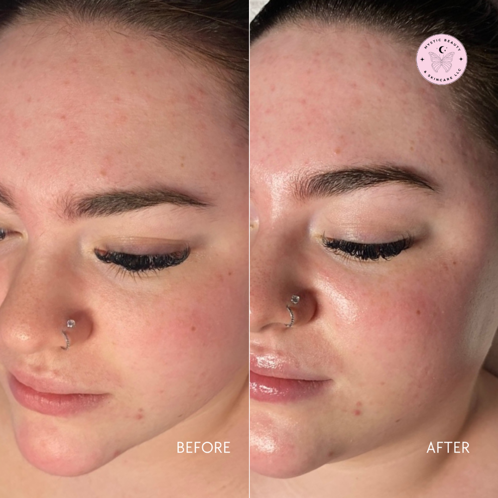 Dermaplane Glow Facial