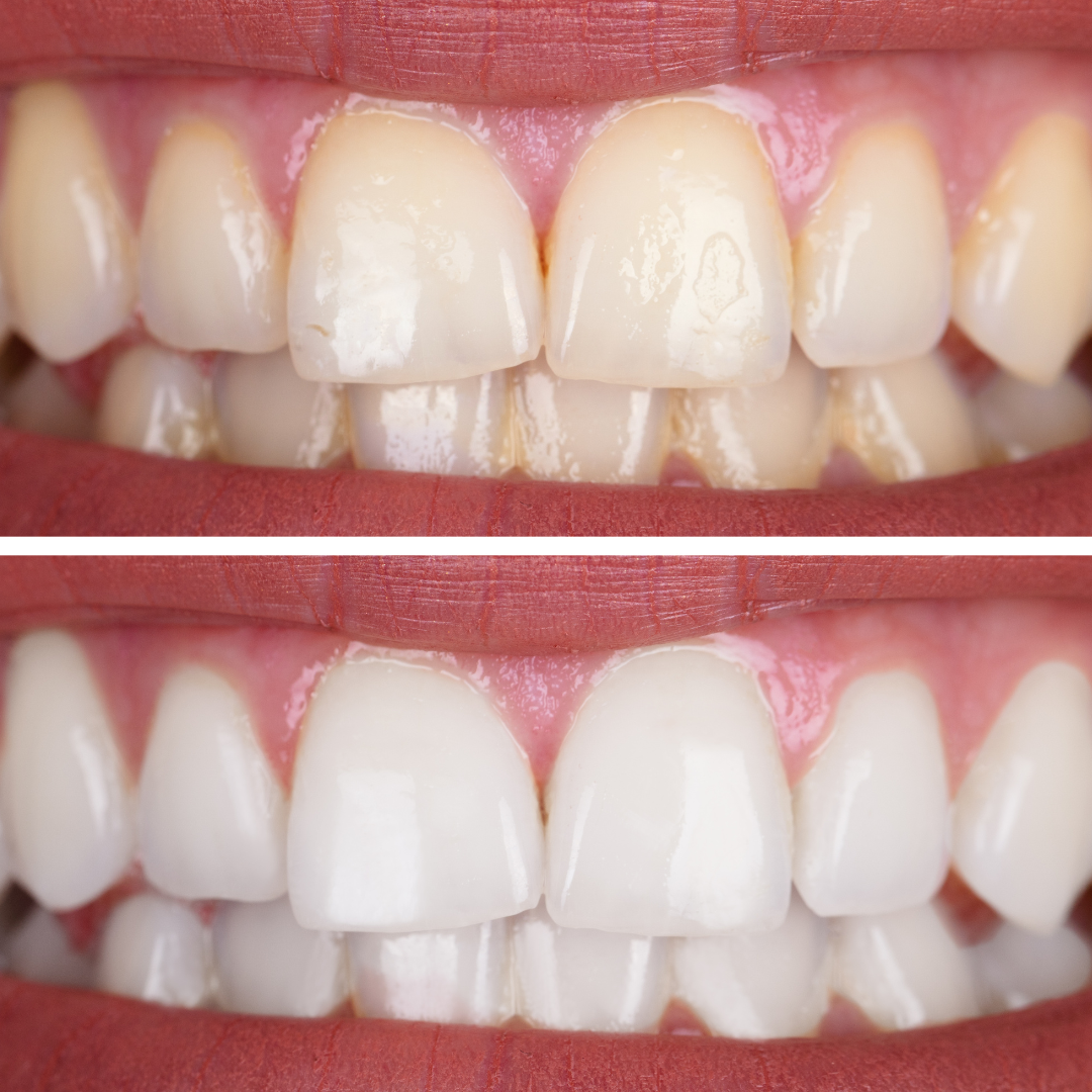 Bella Celebrity Smile