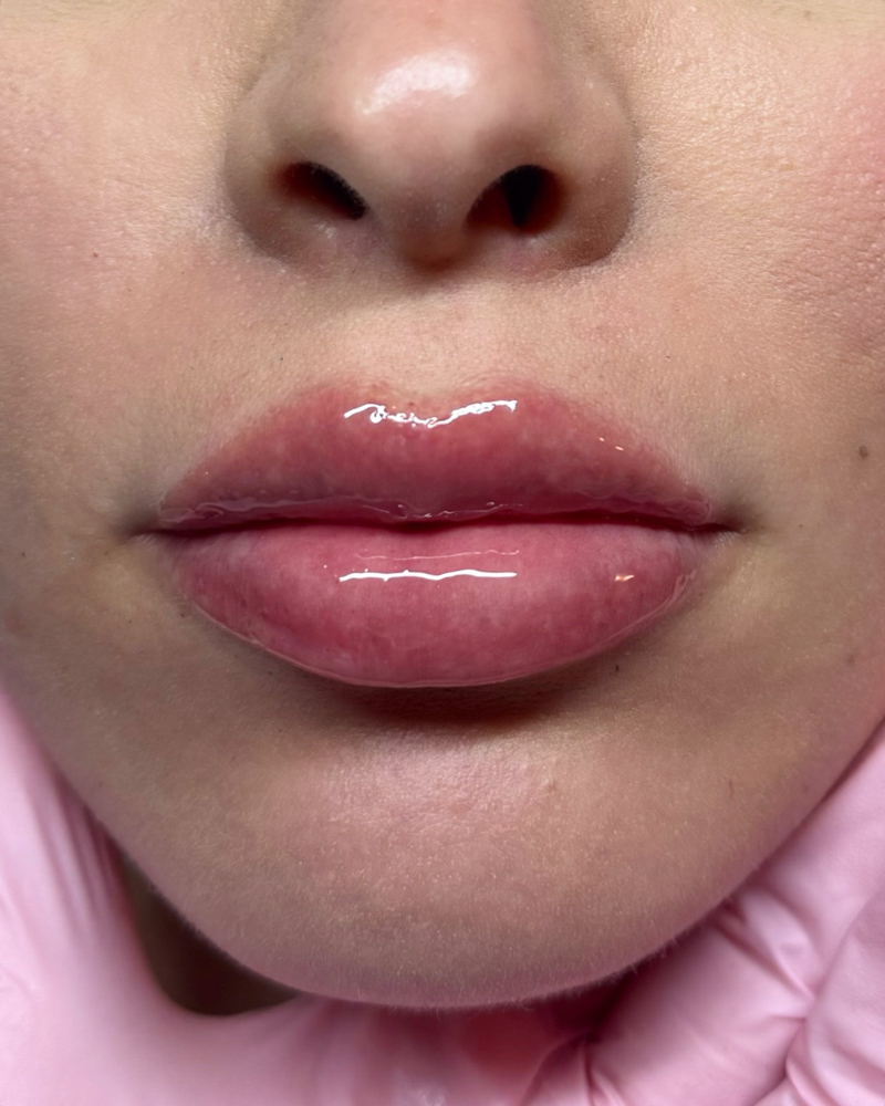 1.5 ML