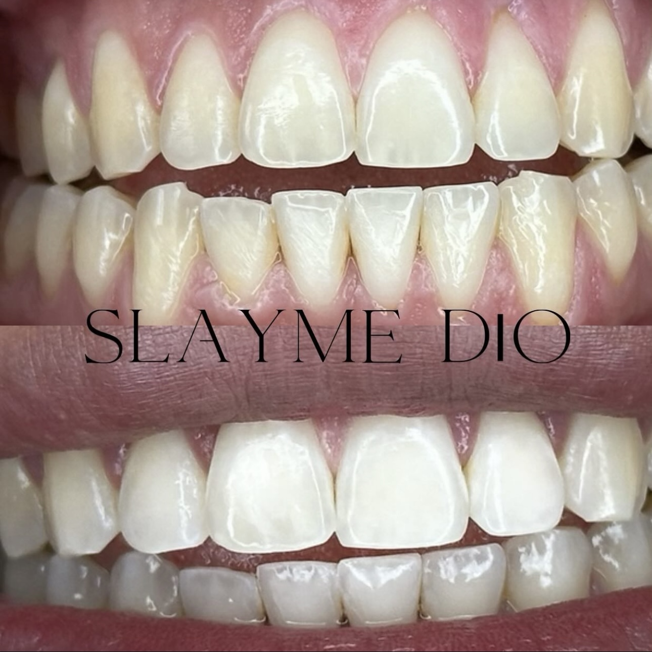 Cosmetic teeth whitening