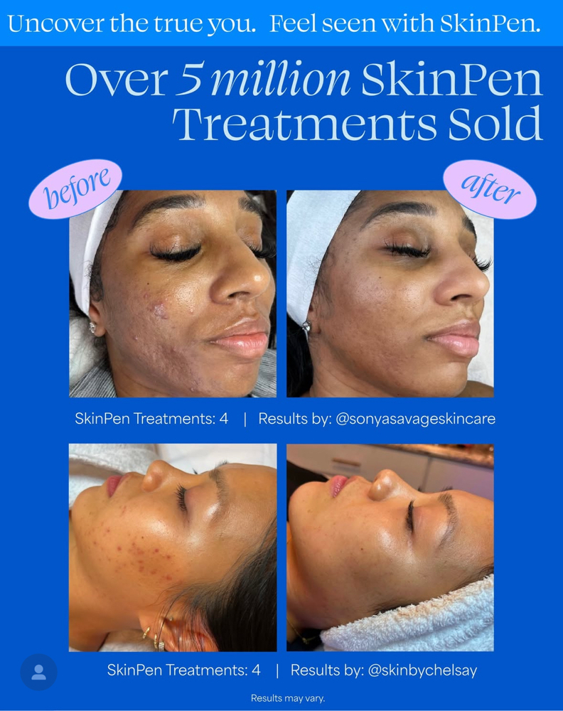 Micrineedling With SkinPen