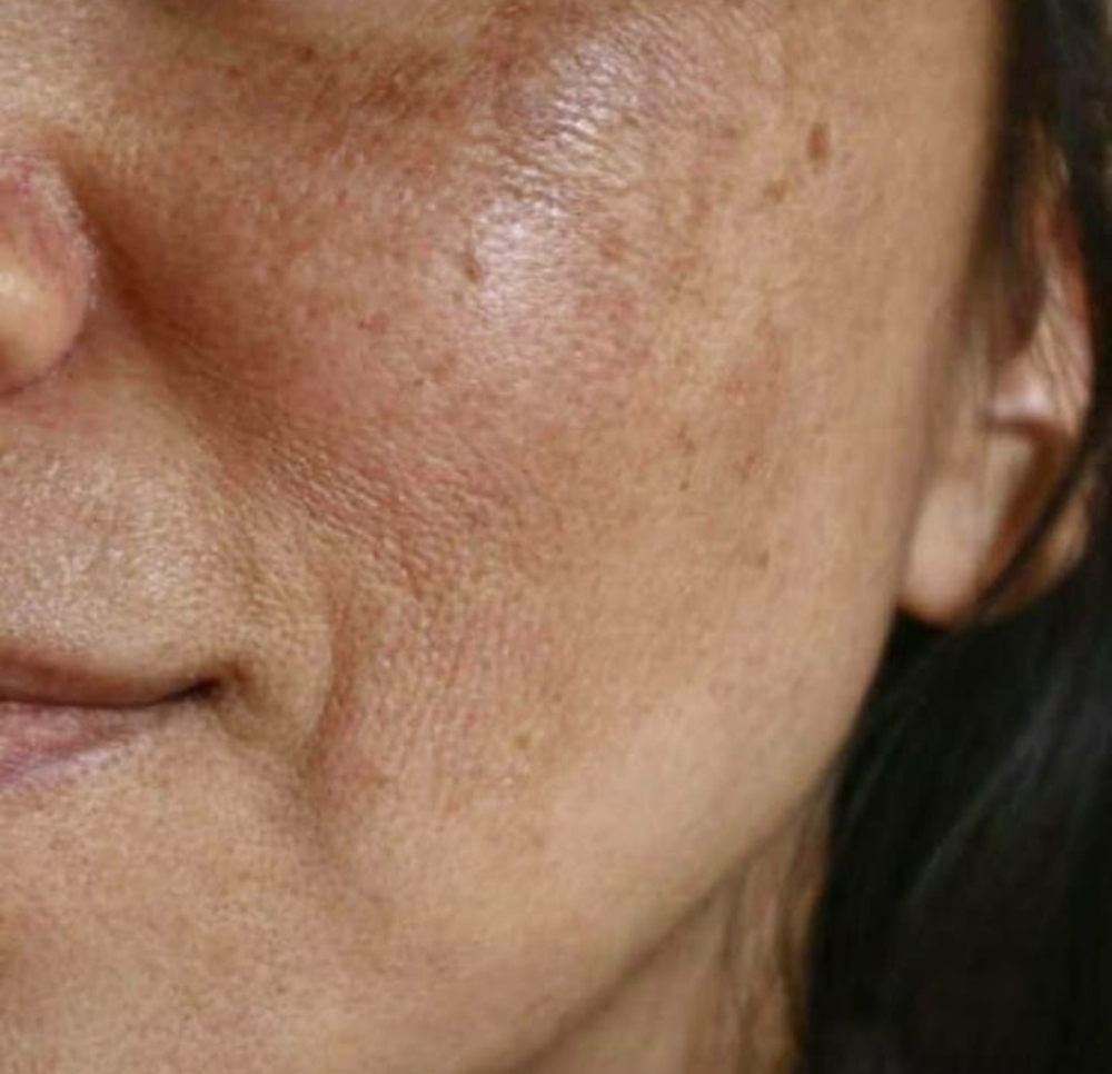 Hyperpigmenation Brightening Facial at High Desert Glow in Santa Fe, NM