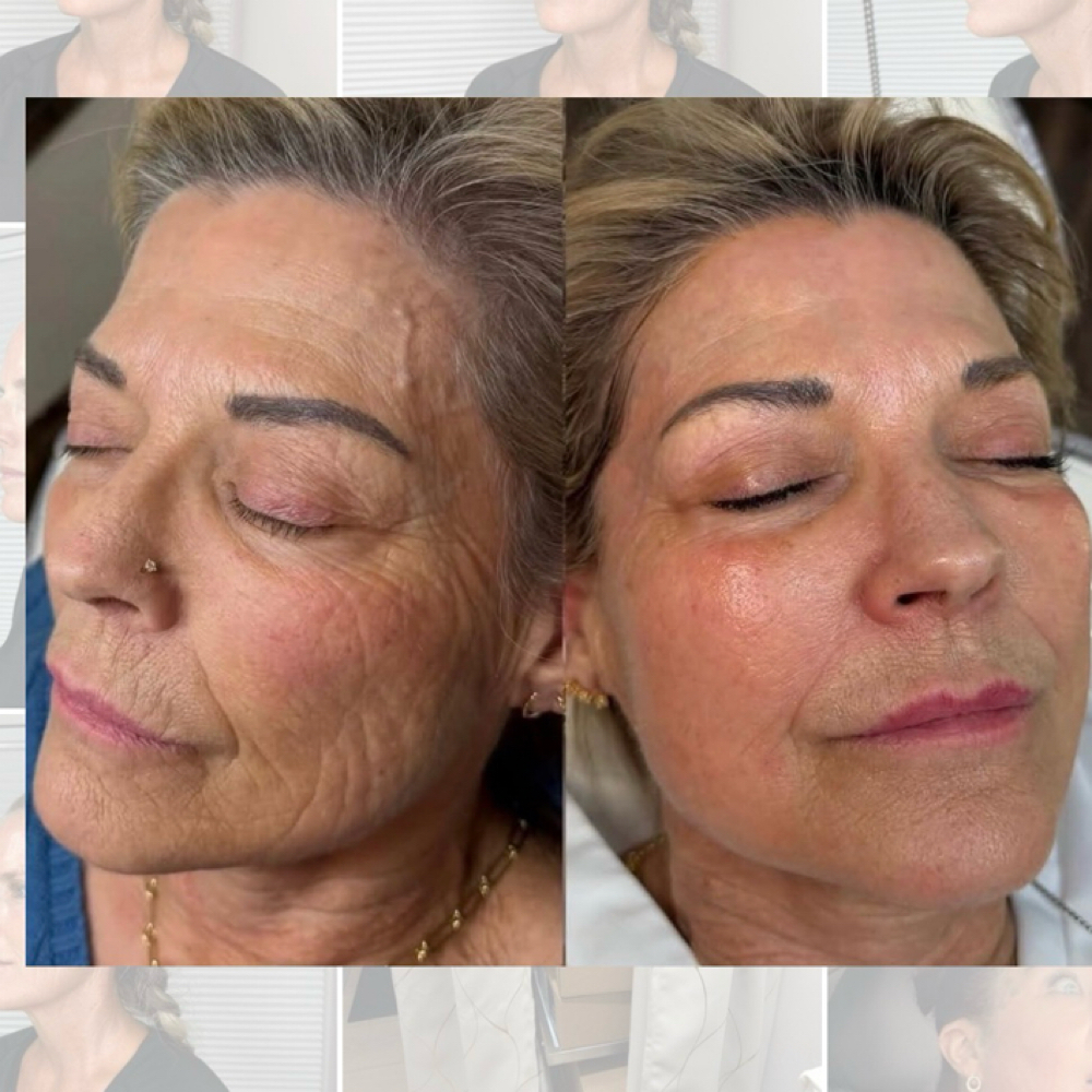 PRX - PLUS with Brightening at Marco Island Aesthetics