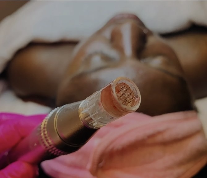 Microneedling with PDRN vamp