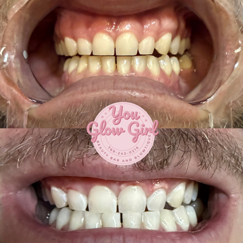 Teeth Whitening at You GLOW Girl Ms Beauty Bar and Blowtique in Picayune, MS