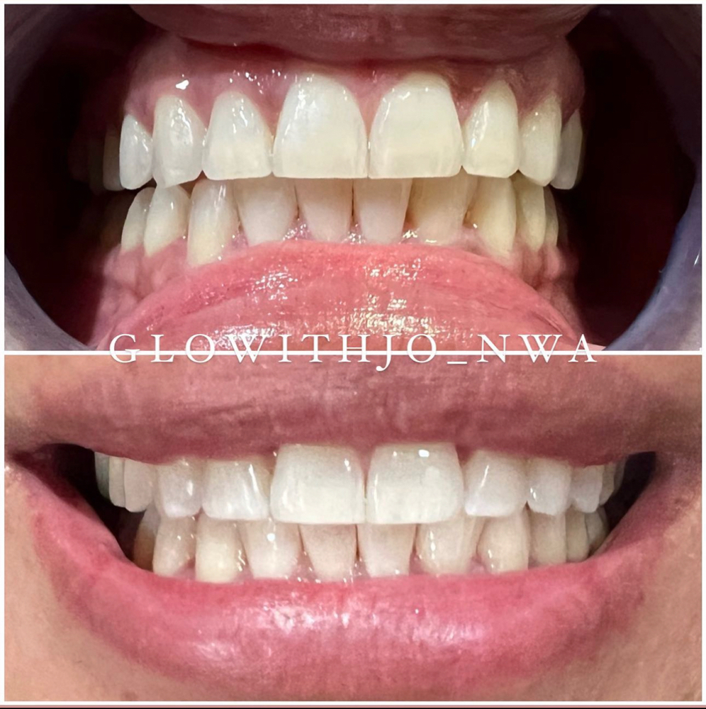 Teeth Whitening