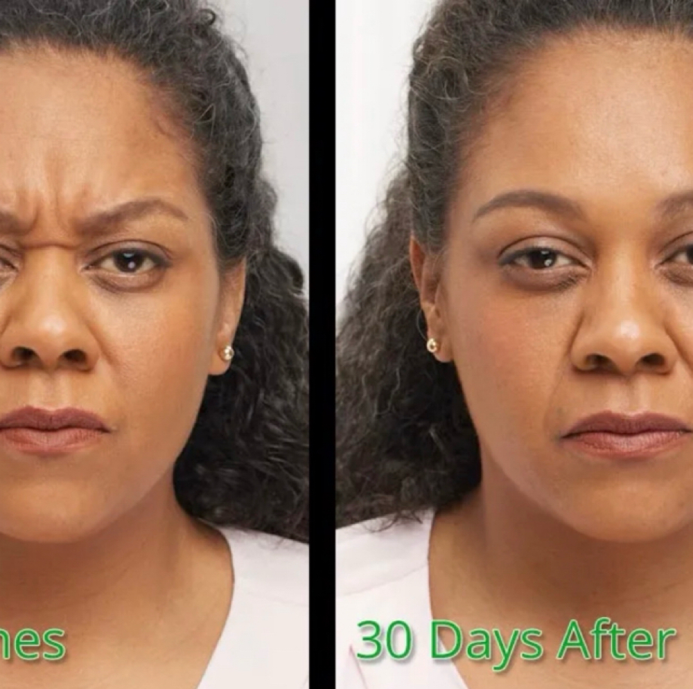 Frown Lines(11 Lines) at Bliss Beauty Bar in Houston, TX