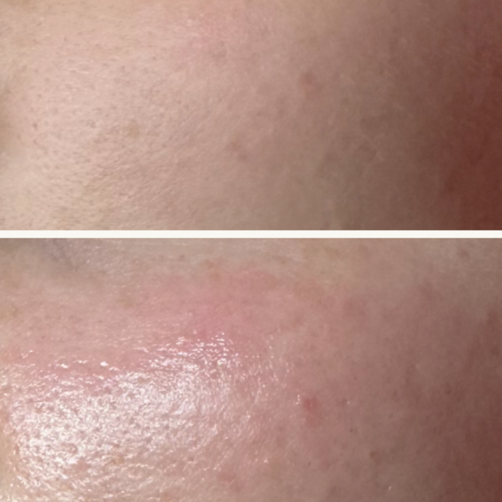 Dermaplaning Stand Alone at Satin Skin Esthetics in South Glens Falls, NY