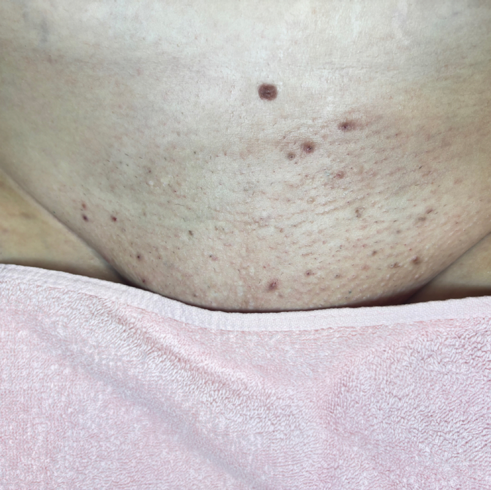 Brazillian Wax at Allure Esthetics in Kenosha, WI