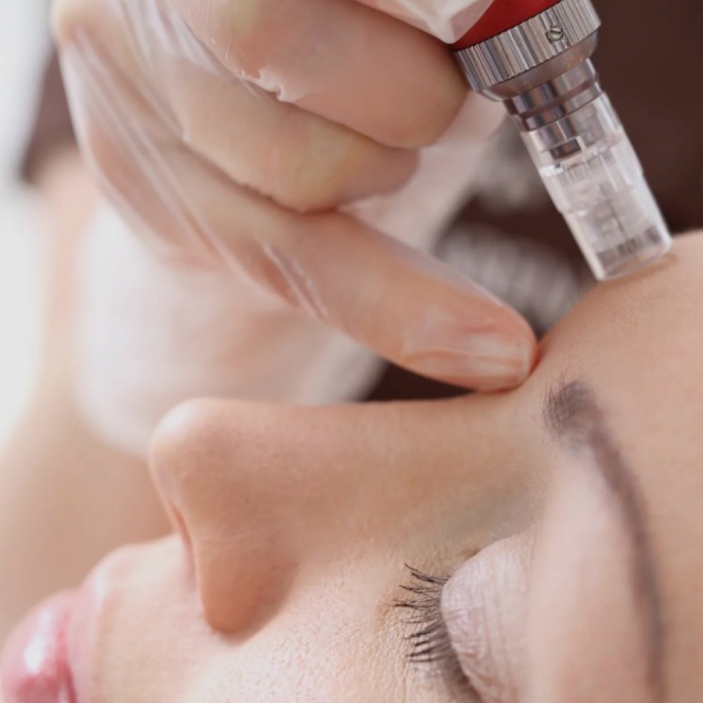 Microneedling With Light Therapy at SKIN by Christine Russell in Green Bay, WI