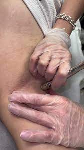 Underarm Microdermabrasion Treatment