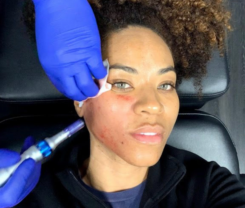 Prp Microneedling 1session