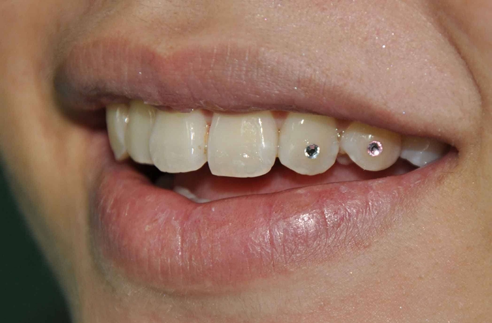 Tooth Gem