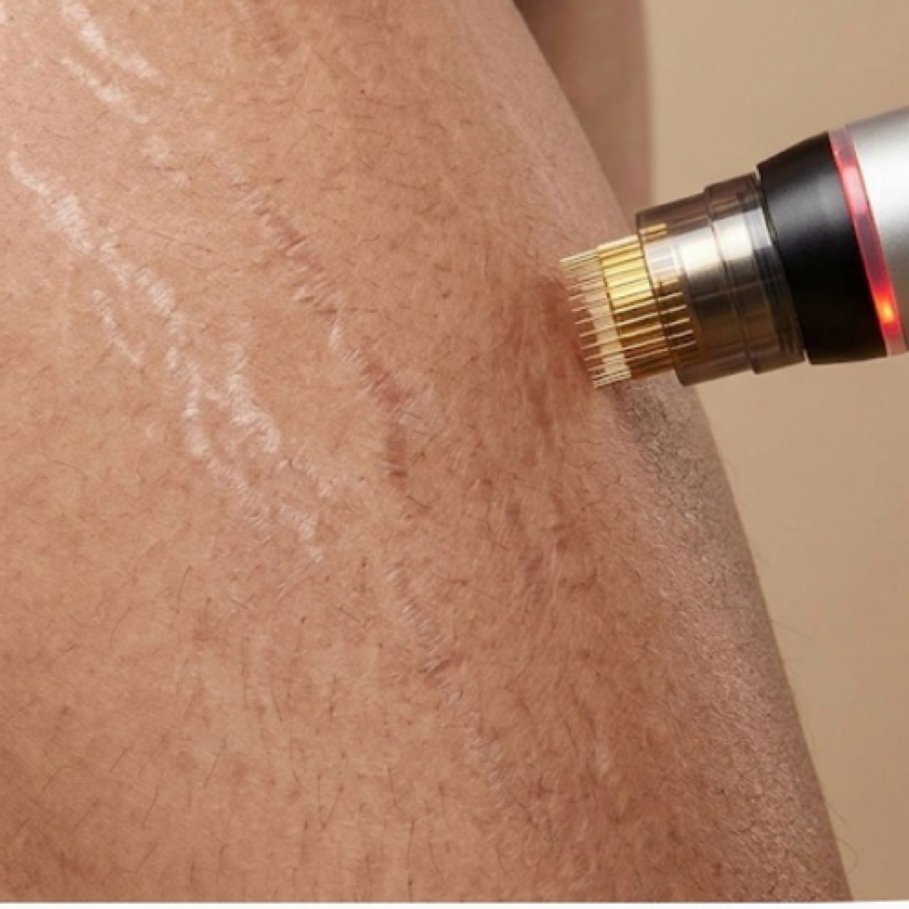 The Stretch Mark Solution at Ann Jay Skin & Body in Clifton, NJ