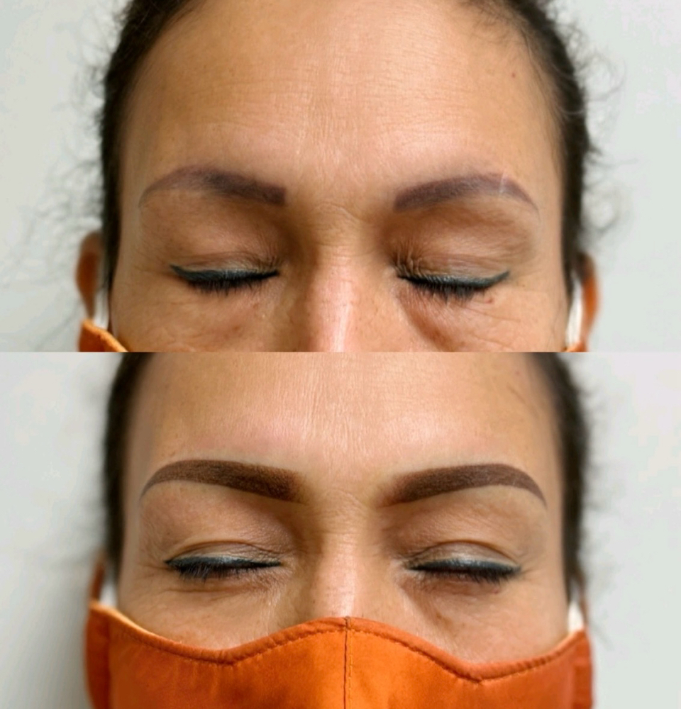 Brow Correction