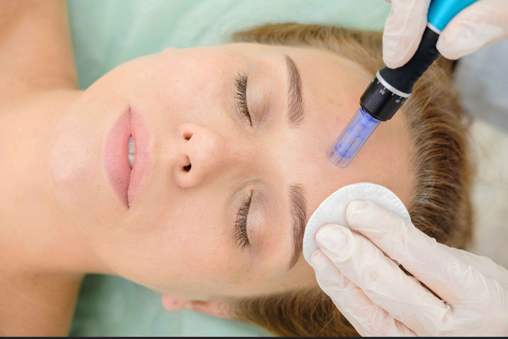 Microneedling