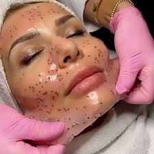 Microdermabrasion Facial