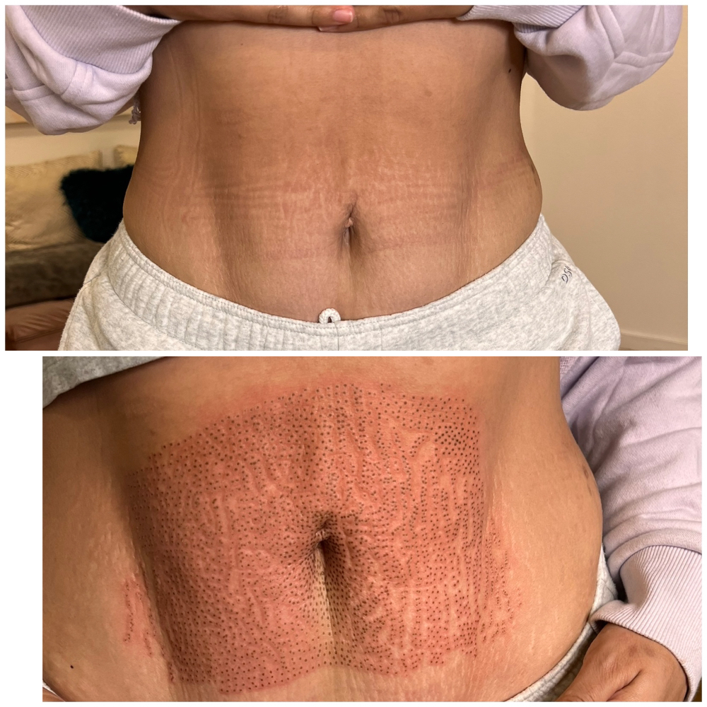 Strech Marks Belly Fibroblast at LASHES AND BROWS By Karla Escorza in Northglenn, CO