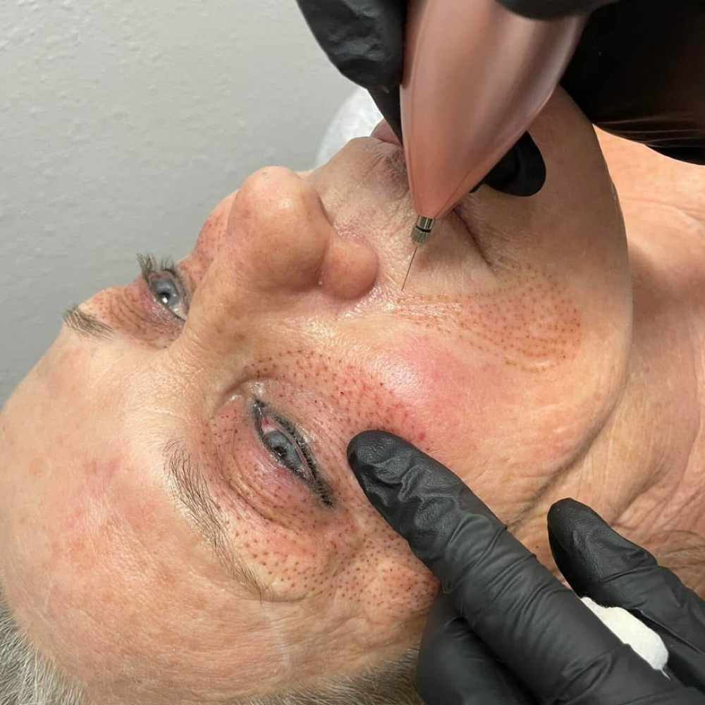 Fibroblast at ARock Beauty & Wellness in San Angelo, TX