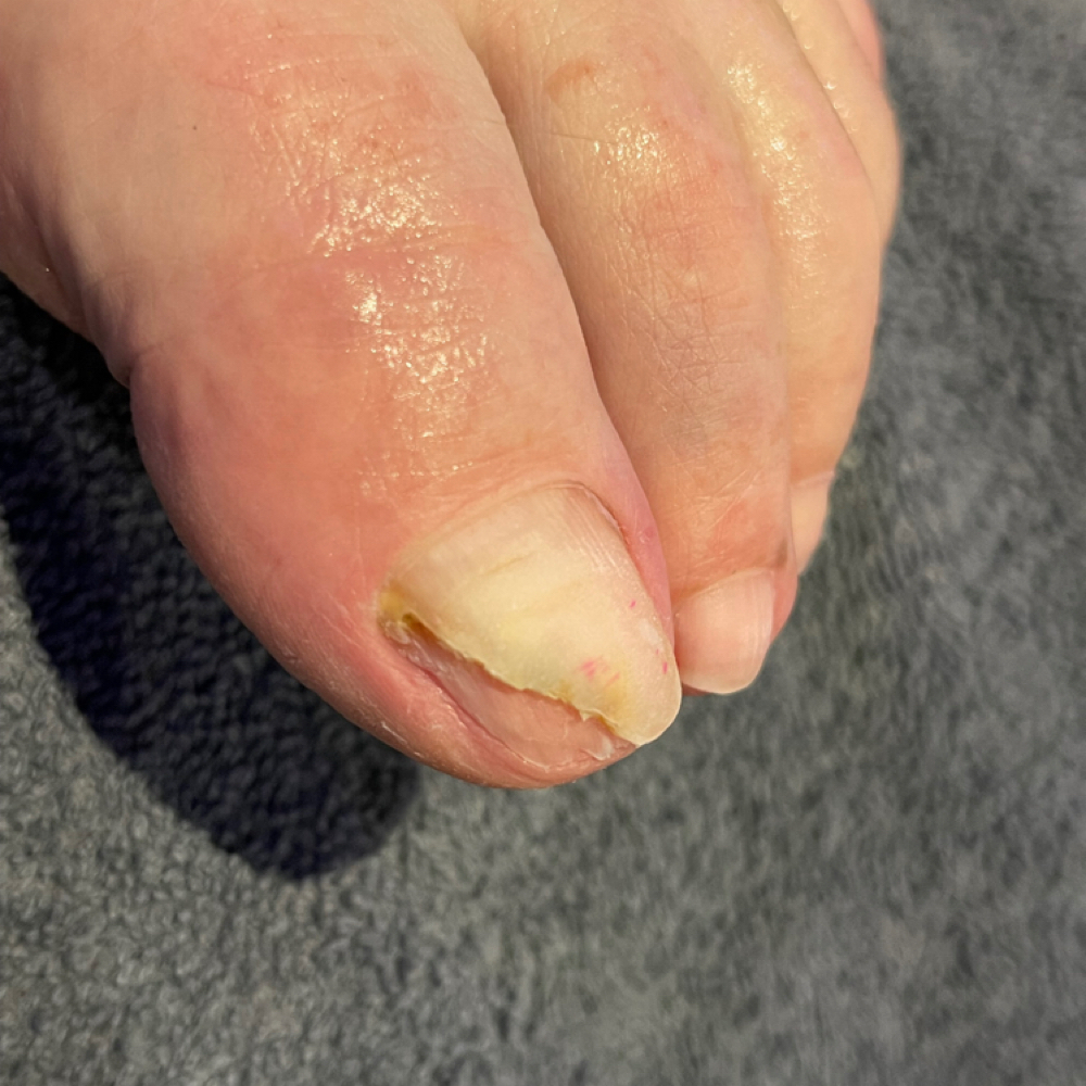 Toenail Acrylic Fix at Savvy Beauty Studio LLC (ELITE suites) in Sioux Falls, SD