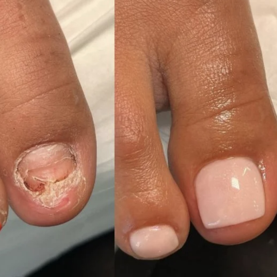 Toenail Acrylic Fix