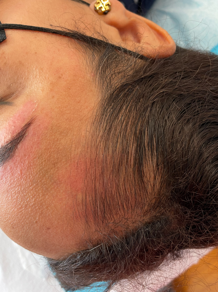 Hairline Micropigmentation