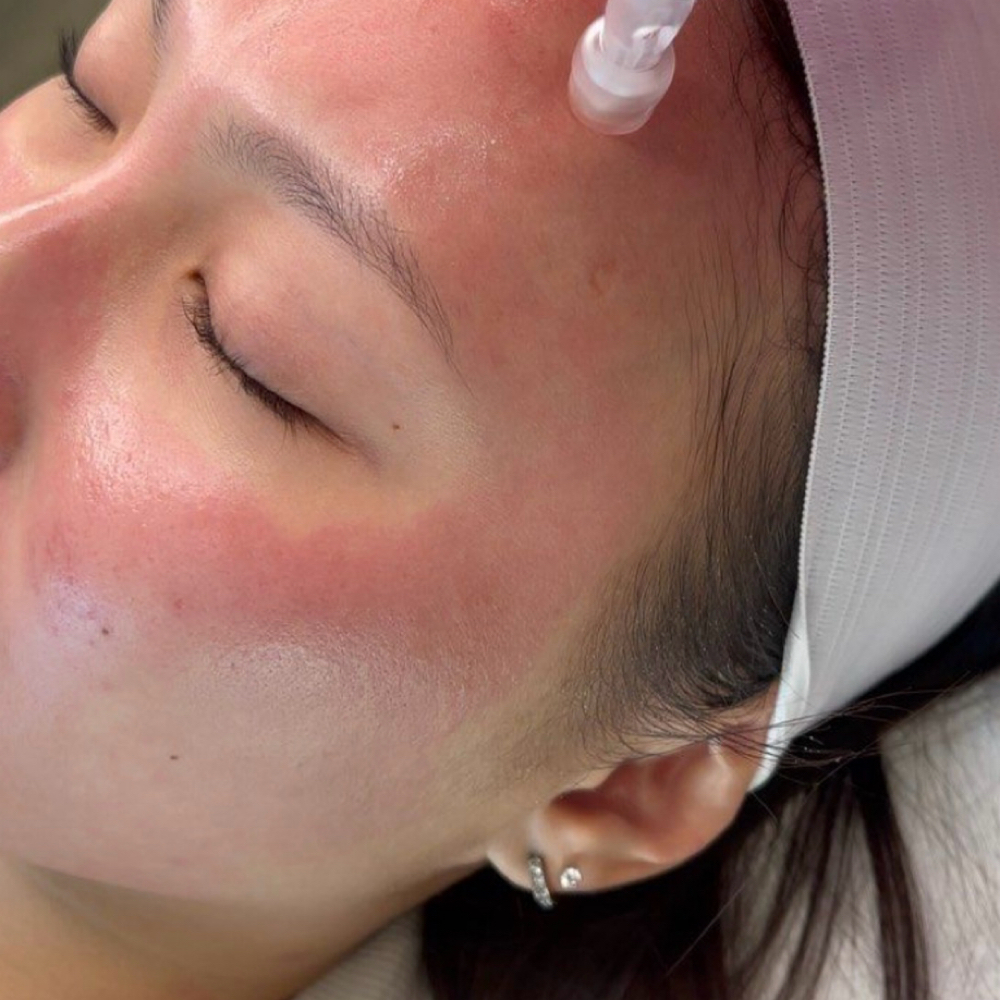 Microneedling with Stem Cell Serum