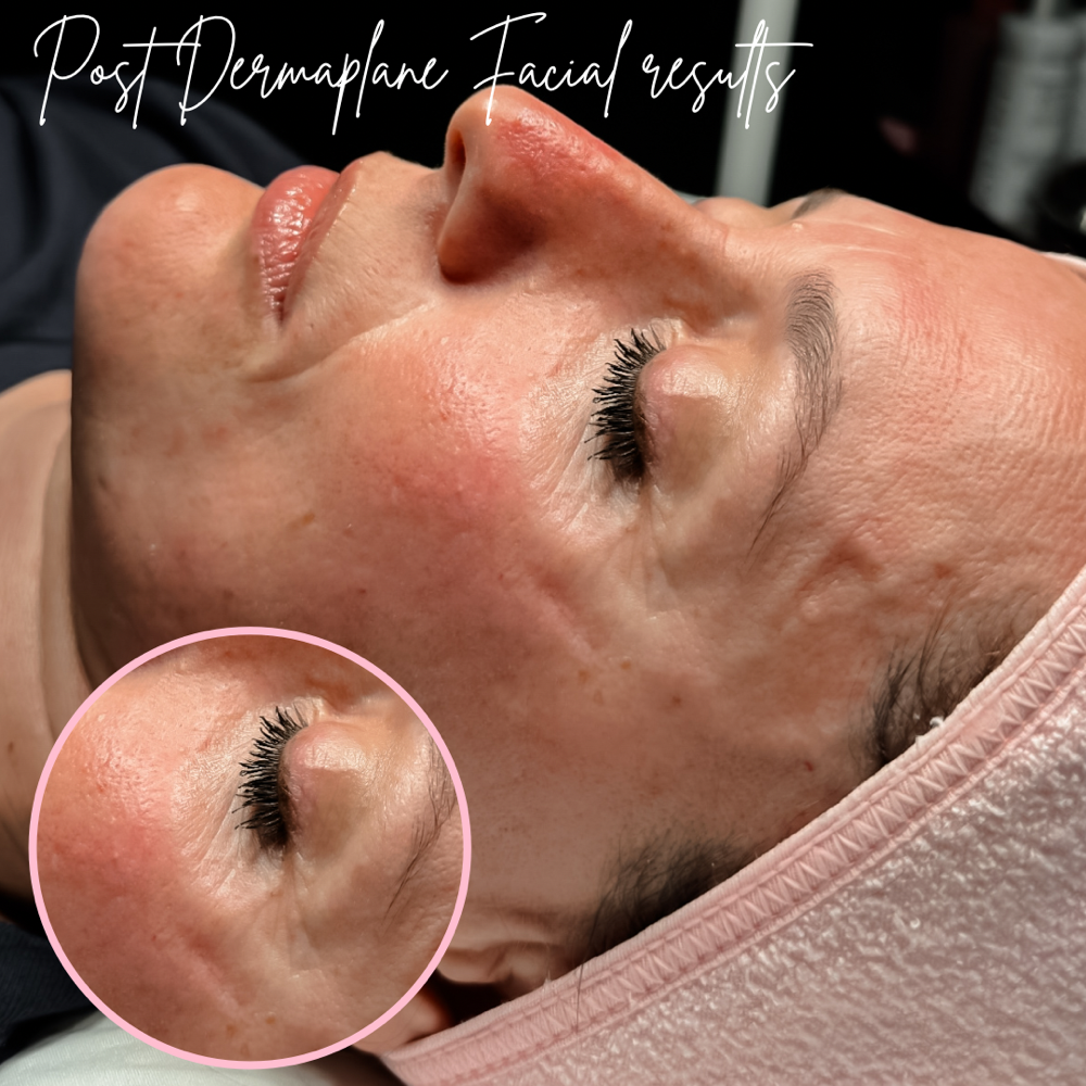 Dermaplane Facial