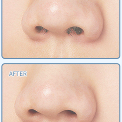 Nose Hair Removal at JPA Atelier Skin Care, LLC in Charlotte, NC