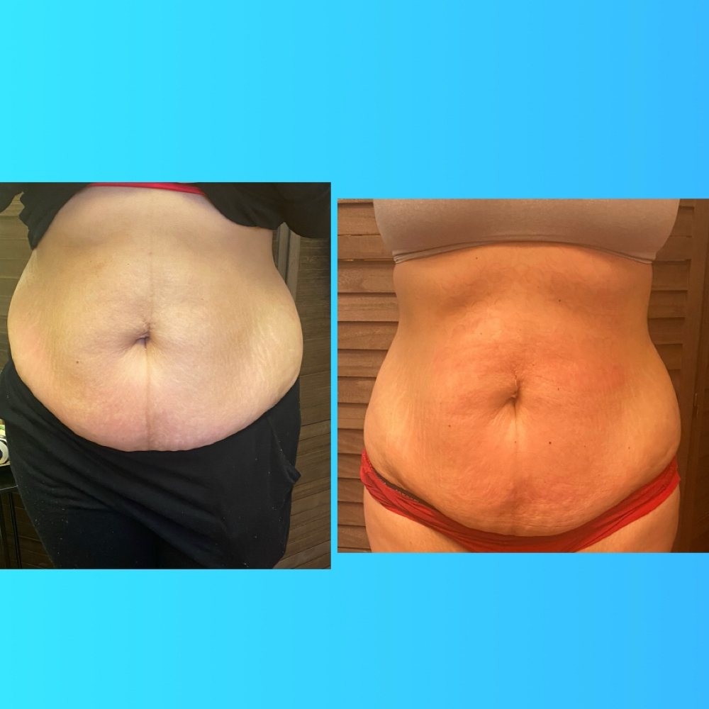 Fat Melting (Tummy) at 210 The Body Bar | San Antonio Lux Spray Tans & Body Sculpting in San Antonio, TX