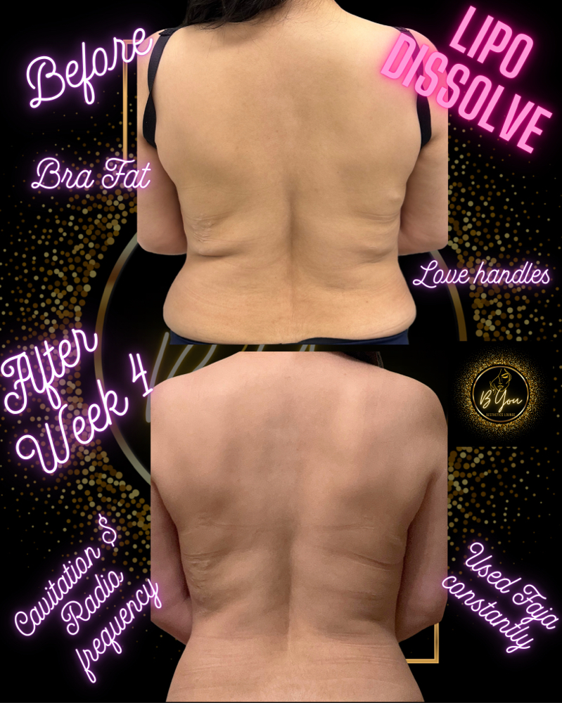 Lipo Dissolve On Medium Areas