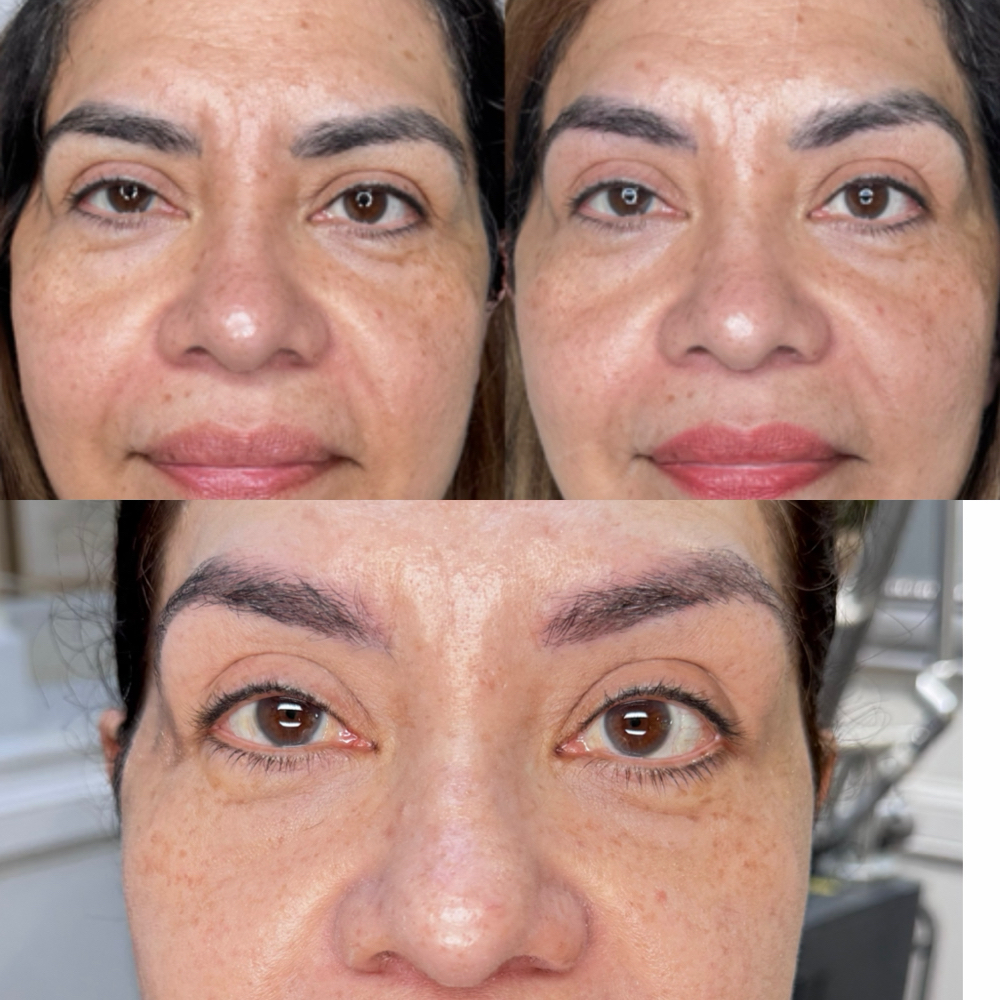 Skin Resurfacing For Wrinkles at Trinity's Touch in Cambridge, MA