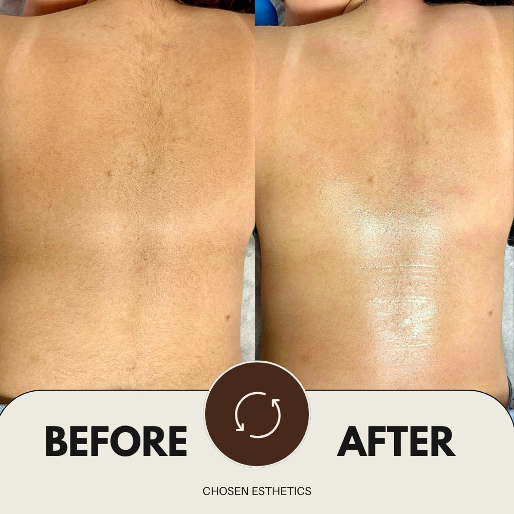 Full Back Wax (Women) at Chosen Esthetics in Pasadena, TX