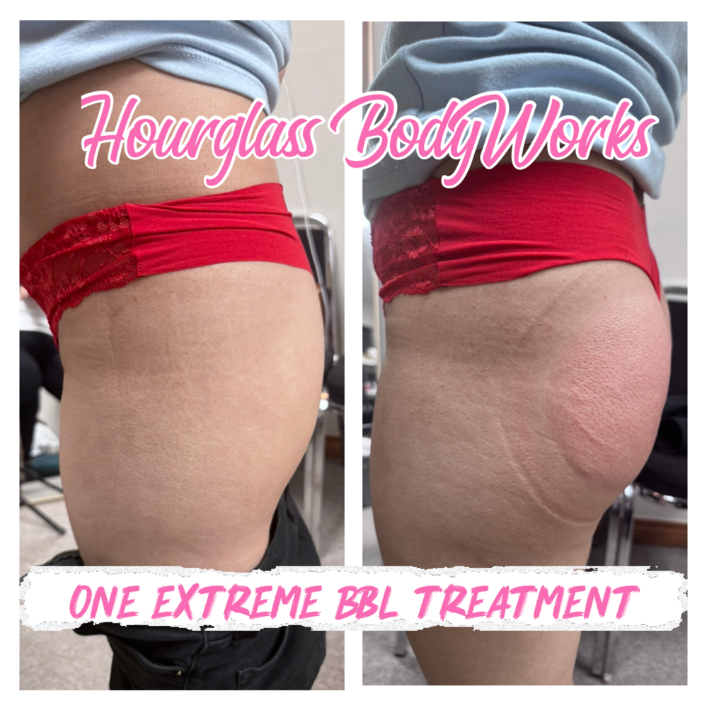 Extreme Non-Invasive BBL