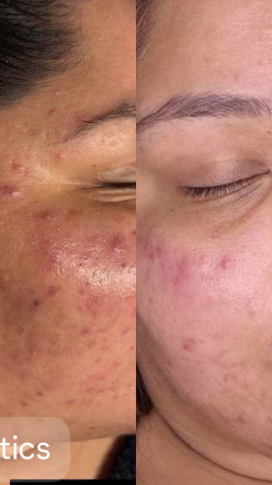 Acne Defense