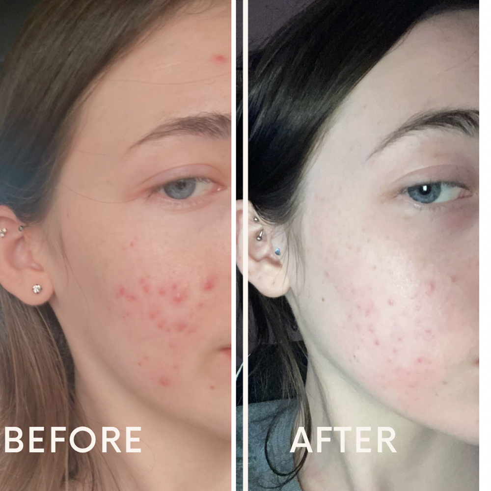 Custom Acne Facial at Meg Skin Co. in Huntersville, NC