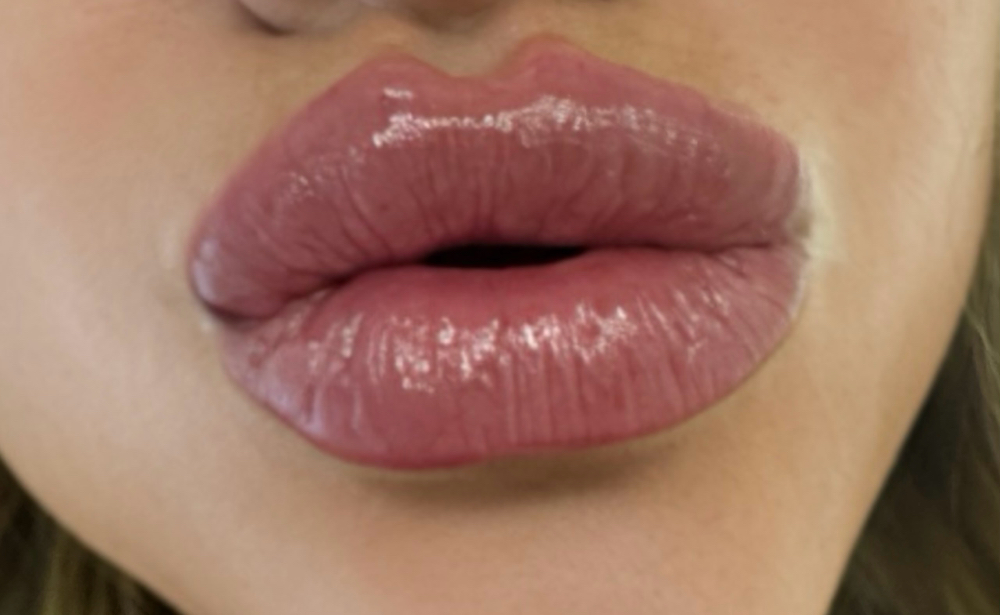 2ML LIP ENHANCEMENT at GLOW BY MARTINA in Grass Valley, CA