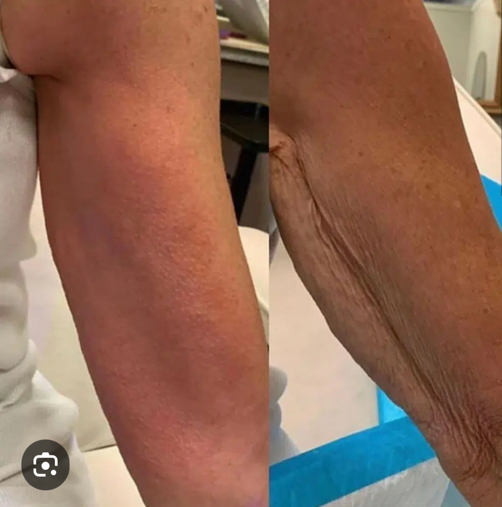 Cryo T Arms Tone/Slim/Sculpt