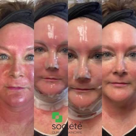 Peptide Mask at Younger Face and Body in Katy, TX