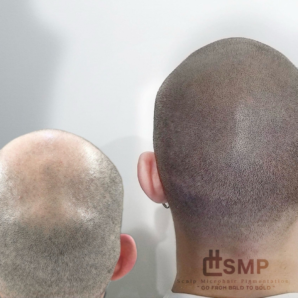 Scalp Micropigmentation at Hannahcbrows in Garden Grove, CA
