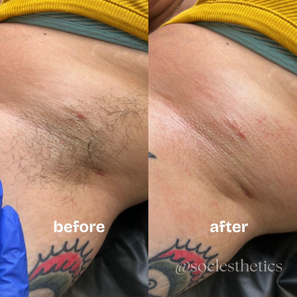 Underarm Wax at SOCL Esthetics in Indianapolis, IN