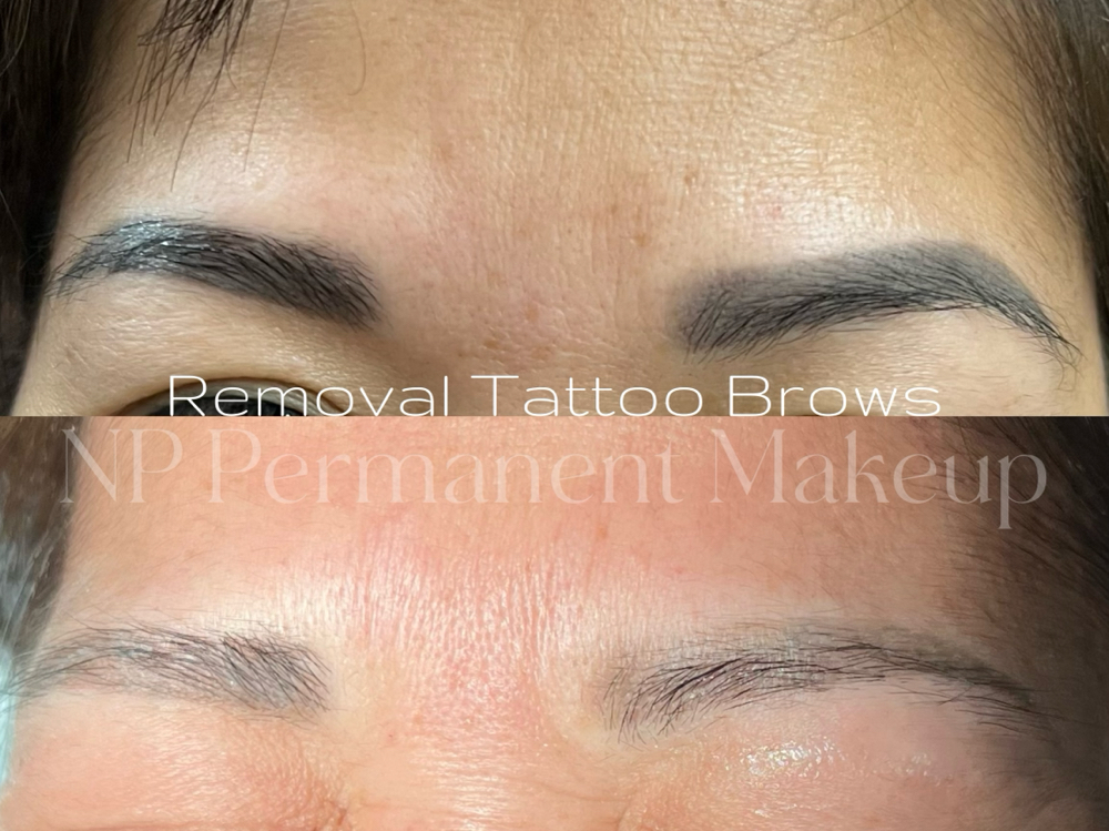 Laser Tattoo Removal at NP Permanent Makeup in Oklahoma, OK