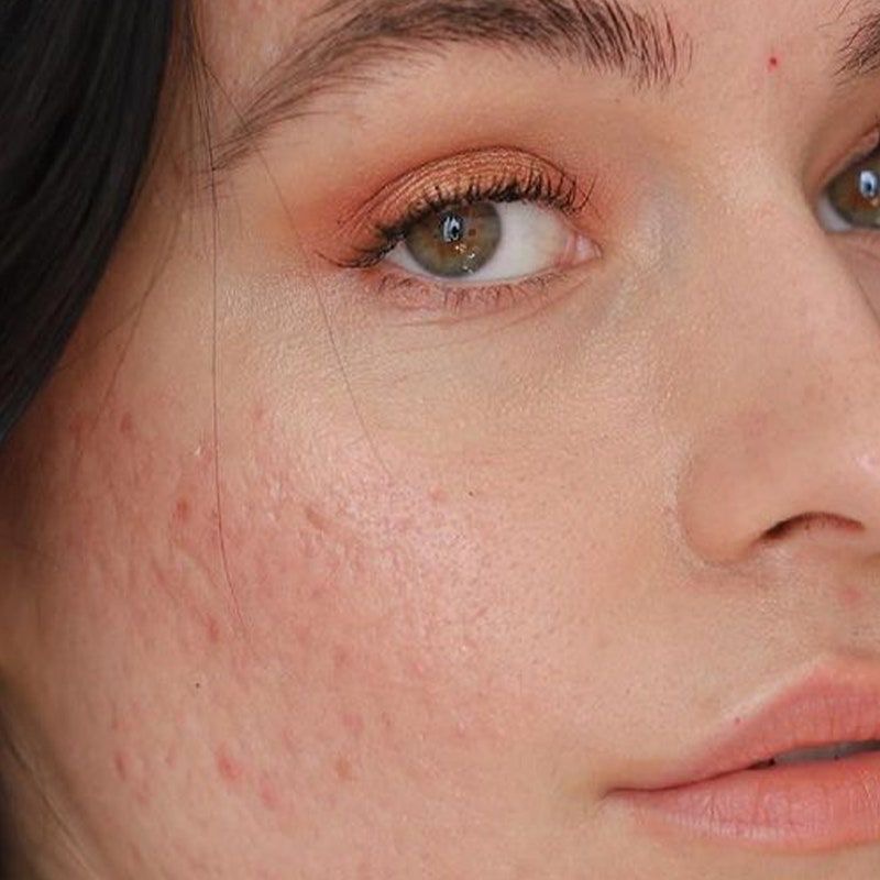 Teen Acne Facial