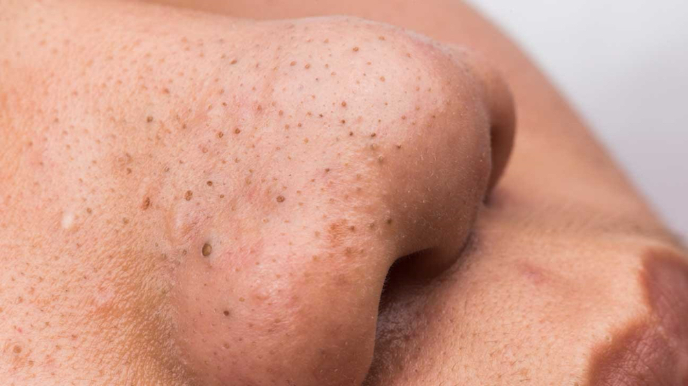 Extended Extractions / Add On