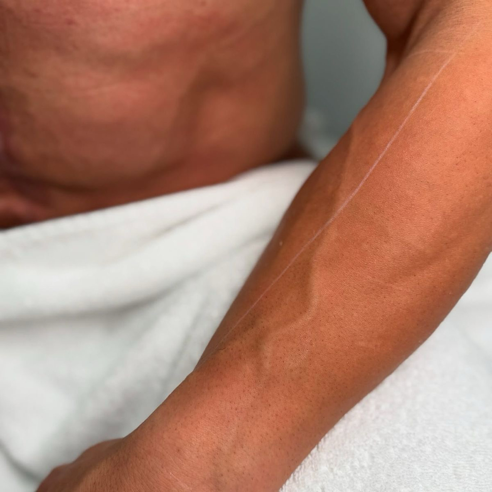 LASER Brazo/Full Arm Men at YubyRo in San Juan, PR