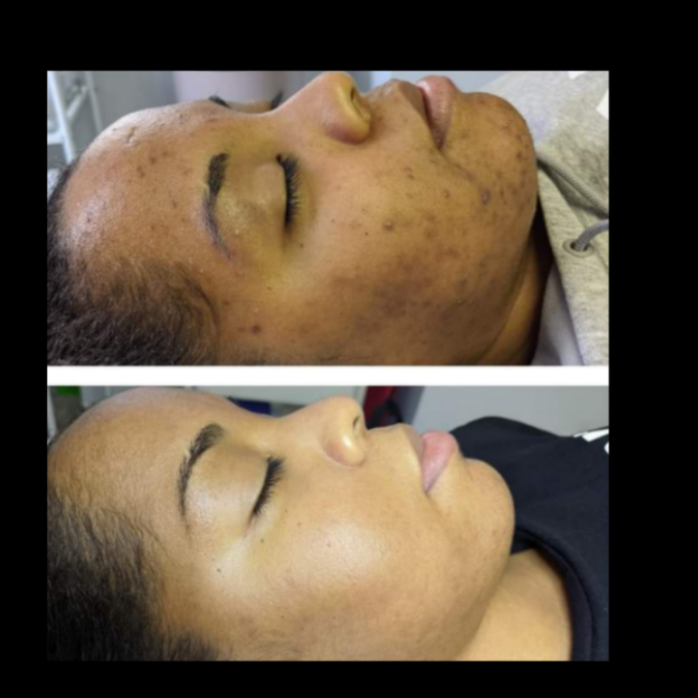 Chemical Peel