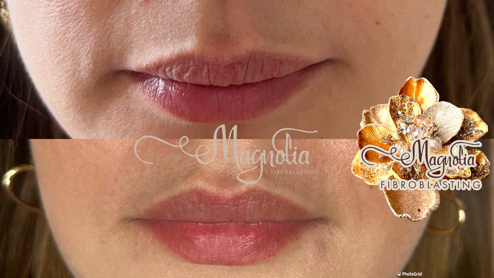 Lip Flip