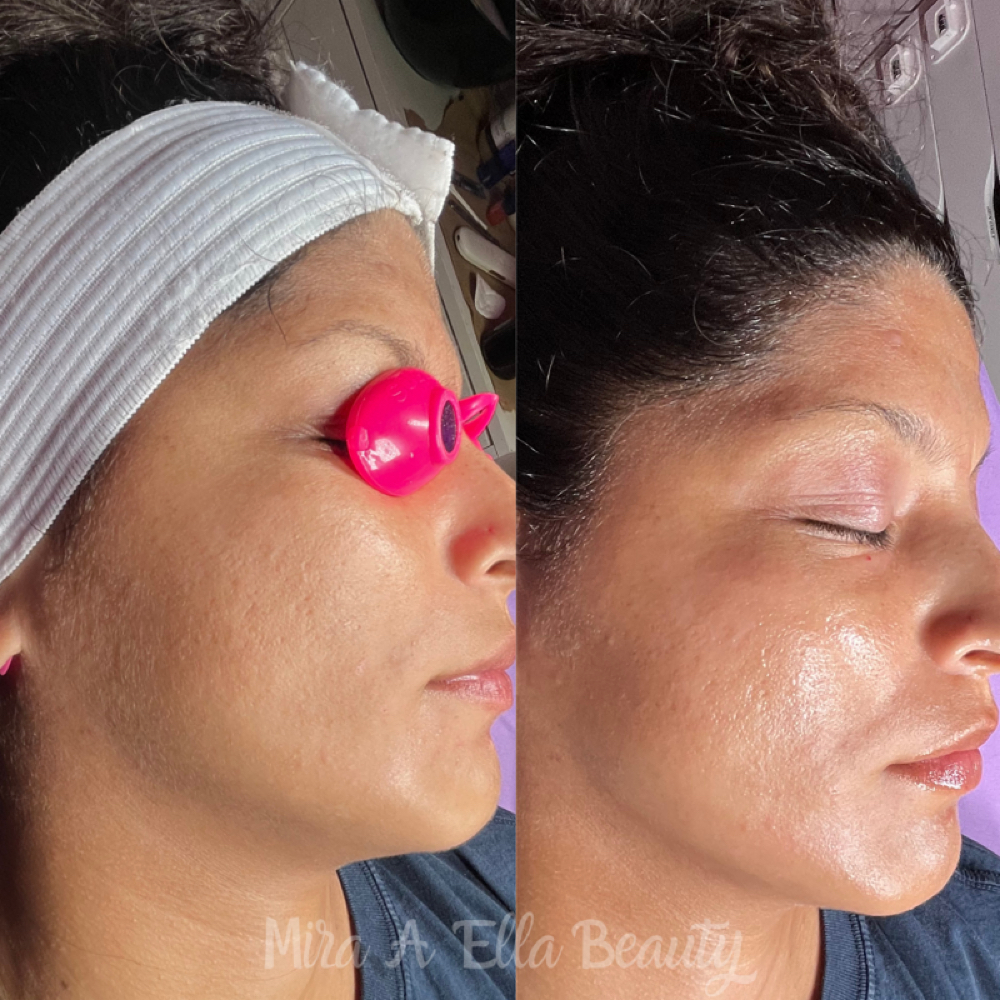 Dermaplane Facial at JA Beauty & Skin in Kansas City, MO