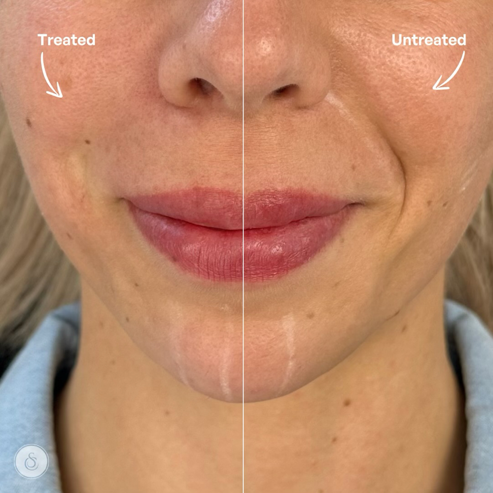 Nasolabial Fold AKA Smile Lines 🎄