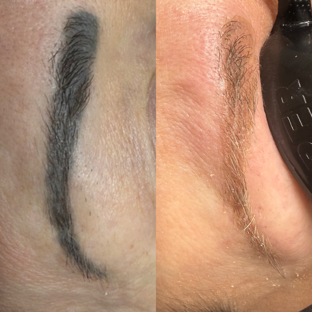 Permanent Eyebrow Removal (1 Sessio